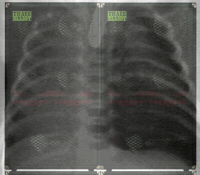 Pneumothorax | Röntgenfoto: A.D.A.M.
